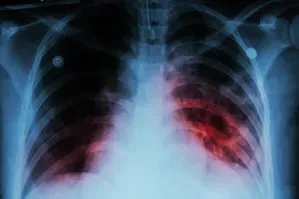 21.69 Lakh TB Cases Reported from January to October: Government Update