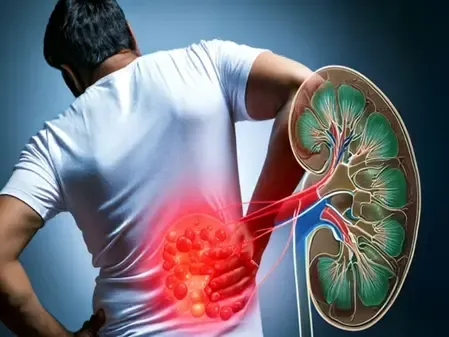 क्या आप किडनी स्टोन को आमंत्रित कर रहे हैं? जानें आयुर्वेद से बचाव के आसान तरीके