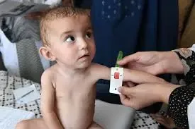 Afghan children with heart disease receive free treatment
