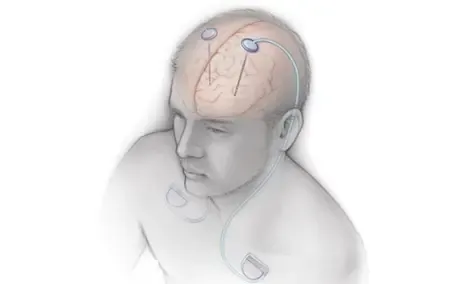 Is AIIMS Leading the Way with India’s First Deep Brain Stimulation Workshop for Parkinson’s and Movement Disorders?