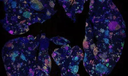 Blood test predicts lung cancer 5 years early, WEHI study finds