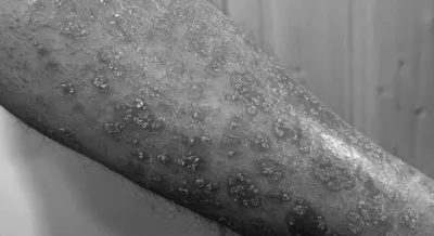 Belly fat may raise risk of psoriasis in women: Study