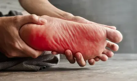 बर्निंग फीट सिंड्रोम: पैरों में जलन के प्रमुख कारण और स्वास्थ्य परिदृश्य
