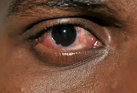 Surge in Conjunctivitis Cases in Chennai: Importance of Hygiene and Timely Treatment