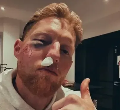 Will Ben Stokes Always Wear a Helmet After His Facial Injury?