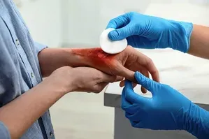 CSIR-IICT surgical adhesive enables rapid wound closure without sutures