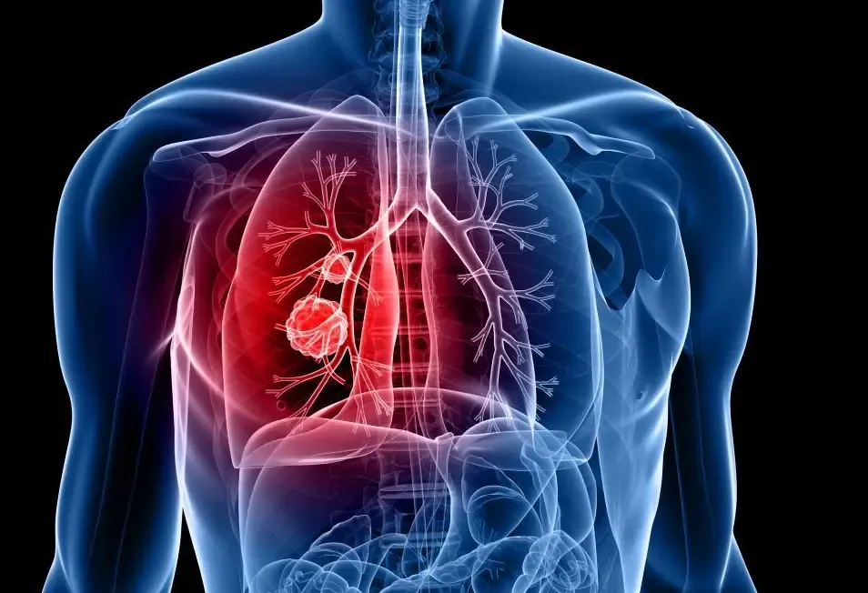 Medical Professionals Alarmed by Increasing Lung Cancer Rates Among Non-Smokers in India