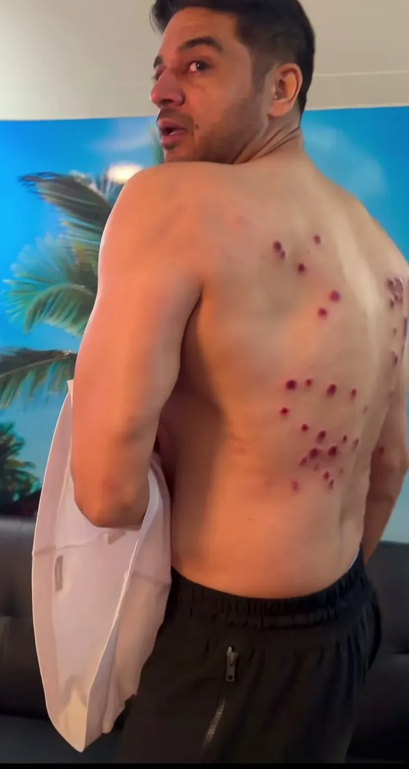 Gaurav Khanna reveals laser burn marks from Khatron Ke Khiladi 15 task