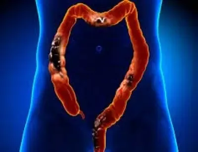 Can Gene-Editing Therapy Revolutionize Treatment for Advanced Colorectal Cancer?