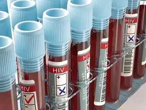 Reduction in Global HIV Funding Could Lead to 10 Million Infections and 3 Million Deaths by 2030: The Lancet