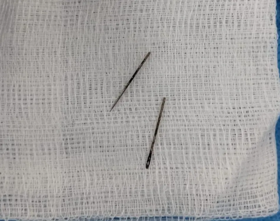 AIIMS Rajkot doctors remove metal pin from girl's intestine via endoscopy