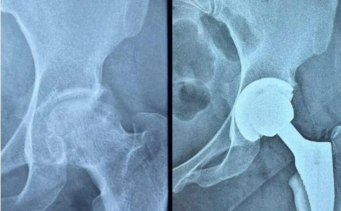 Ahmedabad Civil Hospital performs free hip replacement on ITP patient