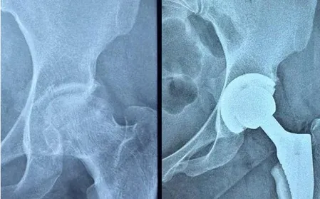 Ahmedabad Civil Hospital performs free hip replacement on ITP patient