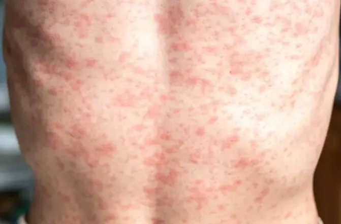 Health Warning Issued for Measles Outbreak in Victoria, Australia