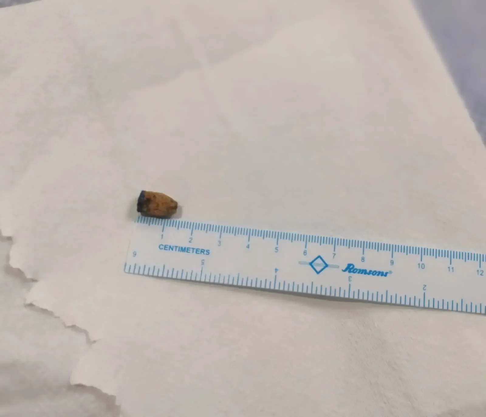 Doctors in Hyderabad Extract Pen Cap from Man's Lungs After 21 Years