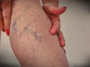 Chilly Feet and Heavy Legs? It Could Indicate Varicose Veins, Research Suggests