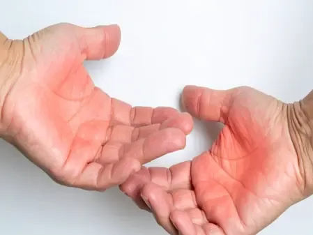 क्या घरेलू नुस्खे जलने से होने वाले जख्म से तुरंत राहत देंगे?