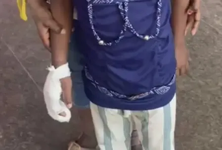 What Happened in K’taka School: FIR Filed Against BEO and Teachers After Class 1 Student Loses Fingers?