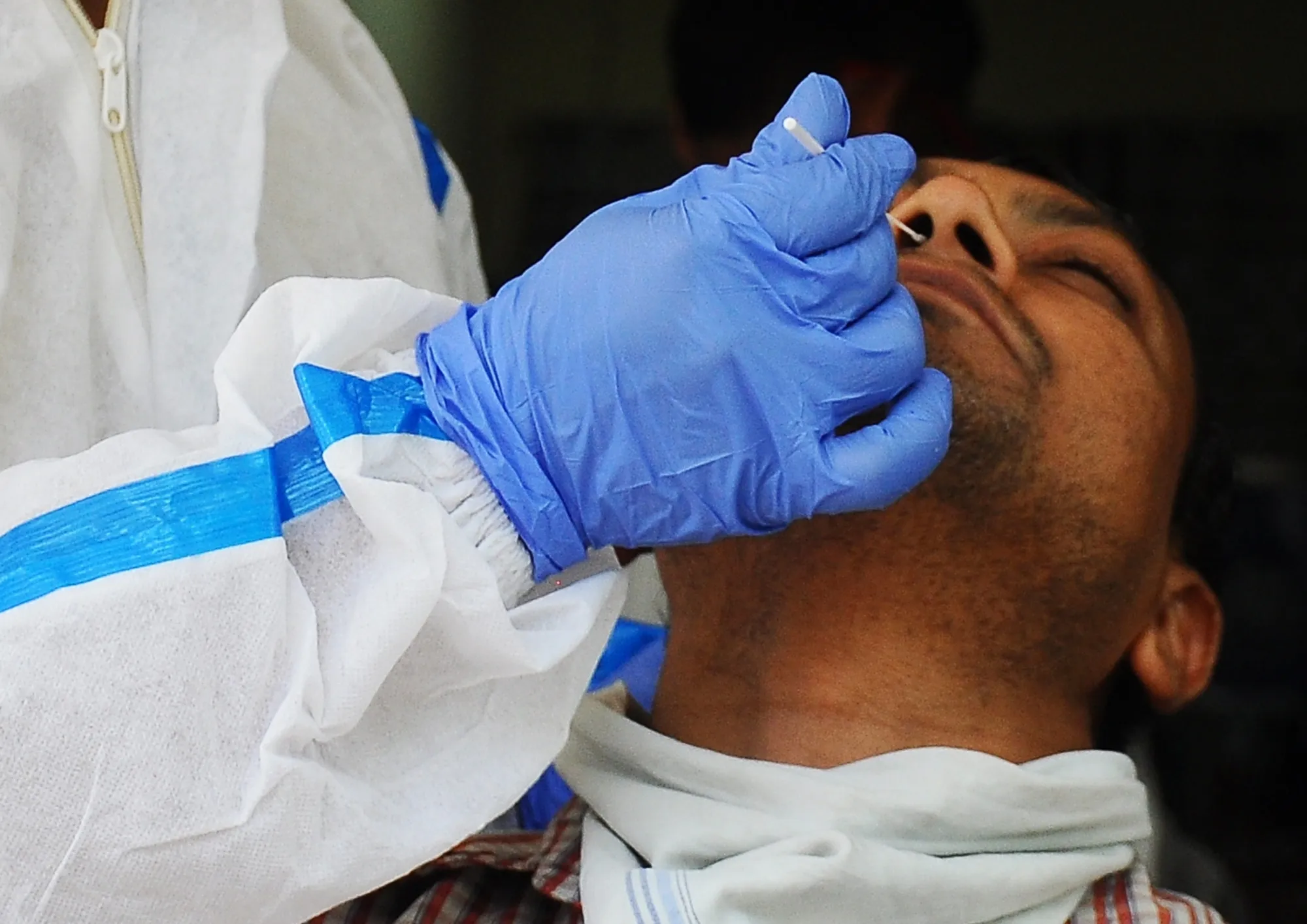 Does Loss of Smell Persist for Years After Covid-19?