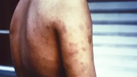Is the Maha government ready to launch a statewide leprosy campaign from November 17?