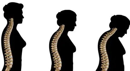 महिलाओं में कैल्शियम की कमी बन रही है बड़ी परेशानी, ऑस्टियोपोरोसिस जैसी बीमारी का खतरा