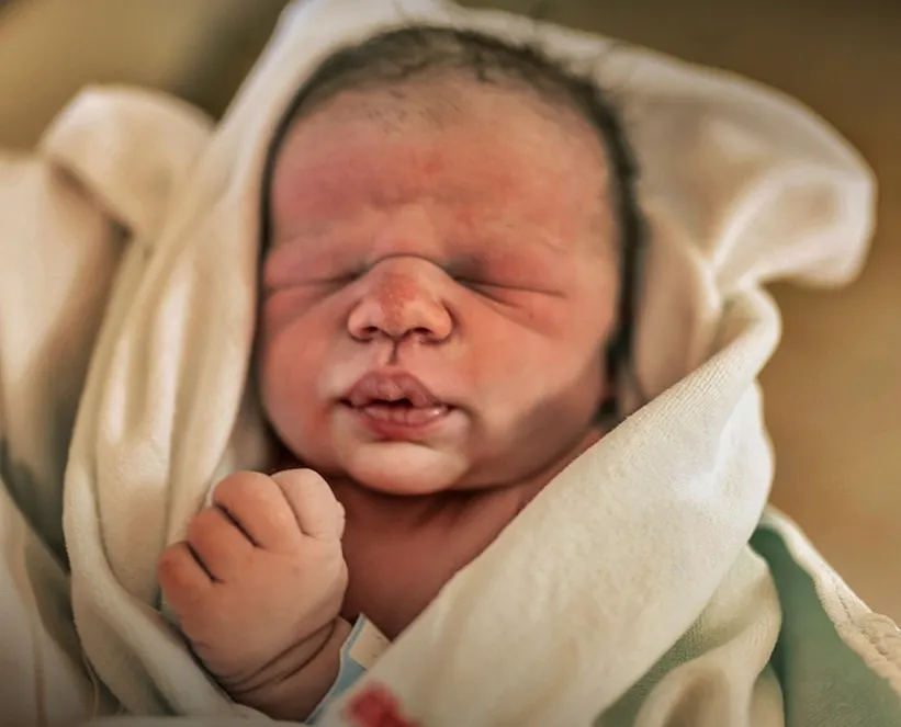 Medical Expert Calls for Prudence as Indian Nationals Pursue Early C-Sections to Evade Trump's Citizenship Directive