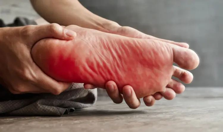 बर्निंग फीट सिंड्रोम: पैरों में जलन के प्रमुख कारण और स्वास्थ्य परिदृश्य