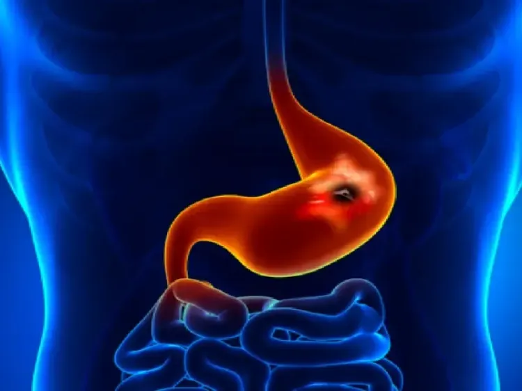 क्या ये आंत से जुड़ी बीमारी चुपचाप पैर पसारती है? लक्षणों को न करें अनदेखा