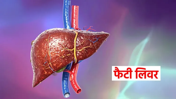 क्या फैटी लिवर एक गंभीर समस्या है? जानें इन आयुर्वेदिक उपायों से कैसे मिलेगा छुटकारा