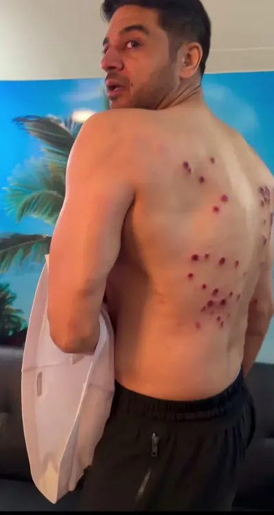 Gaurav Khanna reveals laser burn marks from Khatron Ke Khiladi 15 task