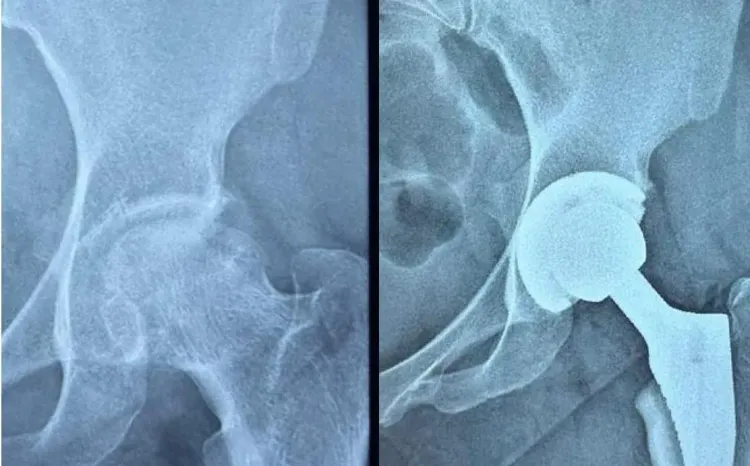 Ahmedabad Civil Hospital performs free hip replacement on ITP patient