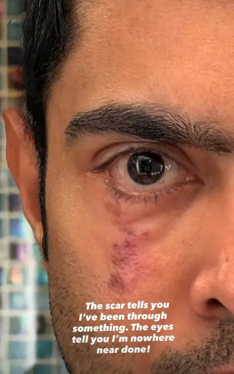 अभिषेक बनर्जी की 'स्कार' इंस्टाग्राम पोस्ट से सियासी हलचल, अमेरिका में इलाज के बीच बना चर्चा का विषय