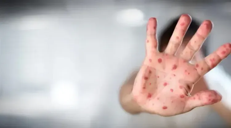Is Israel's Measles Outbreak Expanding to 48 Cases?