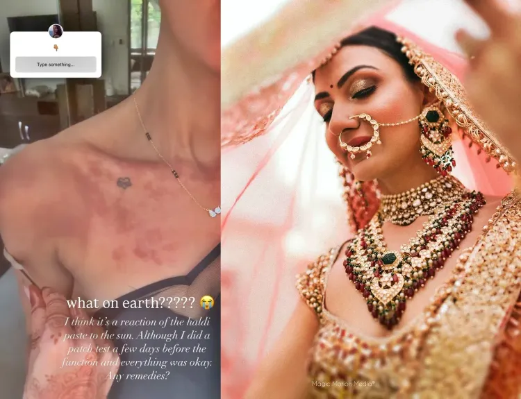 Priyanka Chopra's bhabhi Neelam Upadhyaya suffers burns on her skin