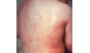 Mongolia Reports Additional Imported Measles Case