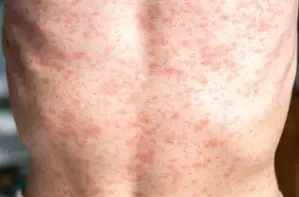 Mongolia Reports Over 50 Confirmed Measles Cases