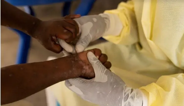Mpox Cases in Africa Approaching 70,000: Africa CDC Update