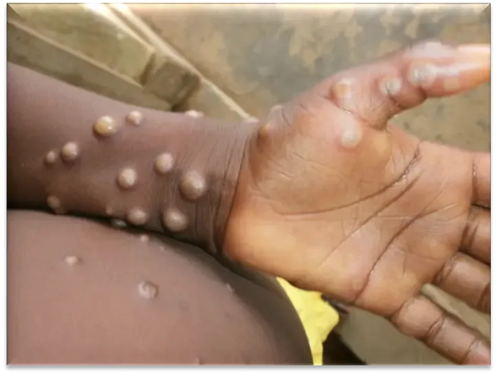 Have Mpox Cases in Africa Surpassed 190,000 with Deaths Approaching 2,000?