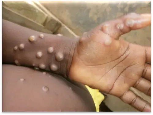 Have Mpox Cases in Africa Surpassed 190,000 with Deaths Approaching 2,000?