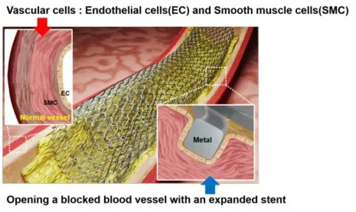 Innovative Laser Patterning Technology Set to Transform Stent Surgery for Cardiovascular Conditions