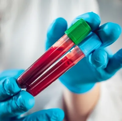 Innovative Approach Promises Enhanced Cancer Monitoring via Blood Tests