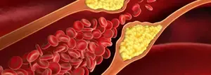 Lower Bad Cholesterol Levels to Combat Alzheimer’s and Dementia