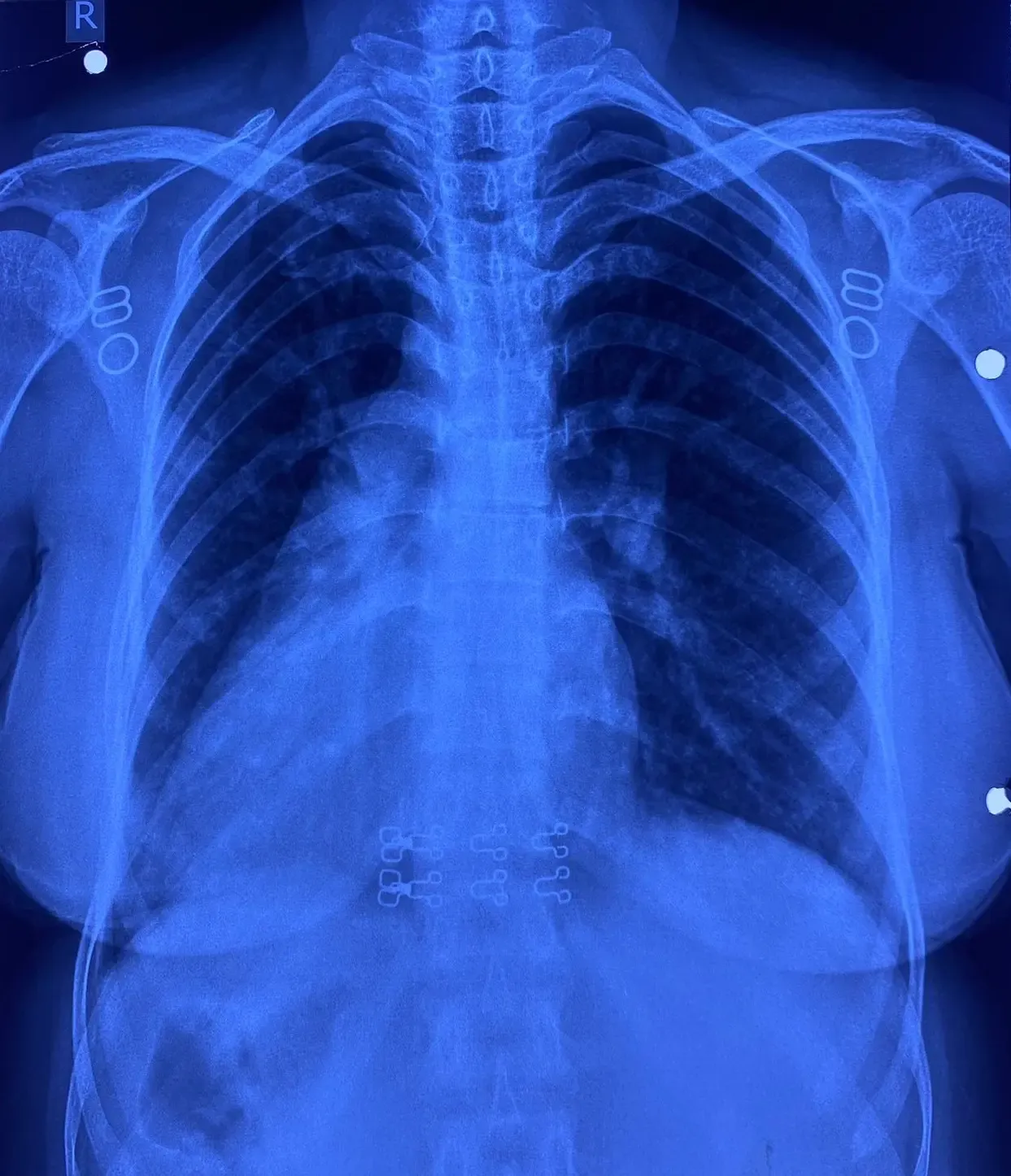 आरएमएल अस्पताल ने की ऐतिहासिक कार्डियक सर्जरी, मिली बड़ी सफलता