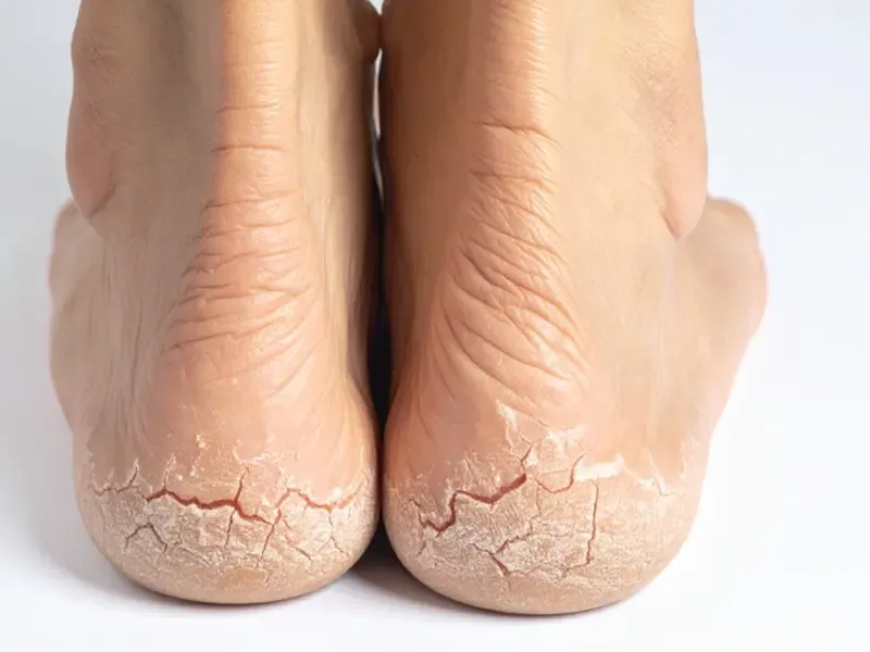 क्या सर्दियों में एड़ी फटने की समस्या से परेशान हैं? जानें आयुर्वेद से उपाय