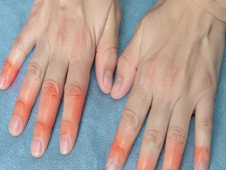 सर्दियों में क्यों हाथ और पैरों की उंगलियों में हो जाती है सूजन? जानें कैसे मिलेगी राहत