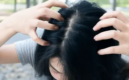 सर्दियों में सिर की खुजली से परेशान? अपनाएं ये आसान उपाय