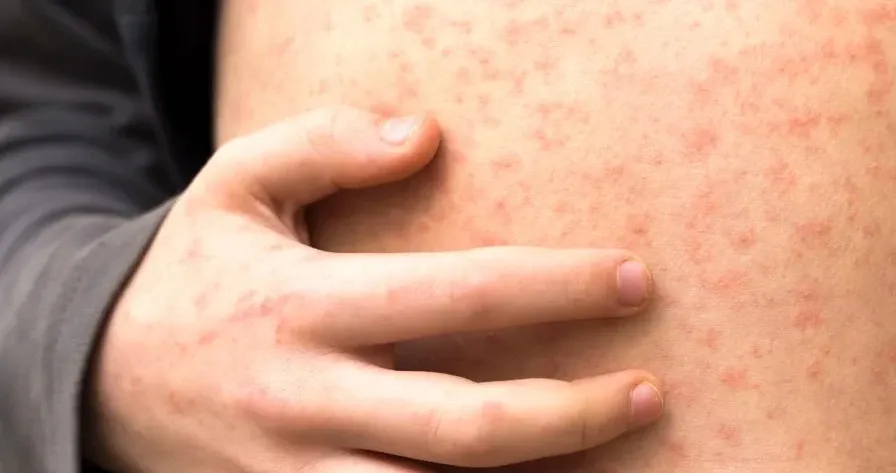 Why Has a Second Child Died from Measles in Mongolia's Capital?