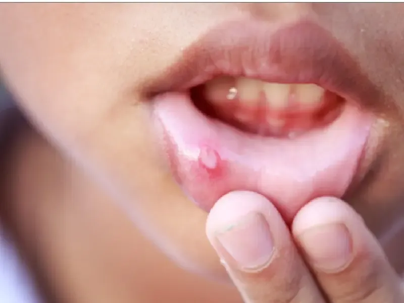 क्या बार-बार मुंह में होने वाले छाले शरीर में पित्त बढ़ने का संकेत हैं?
