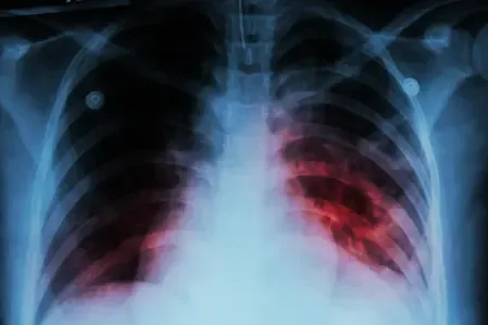 Singapore Sees 1,156 New Tuberculosis Cases in 2024, Down from 2023