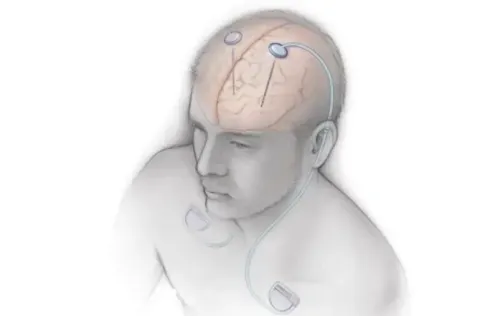 Is AIIMS Leading the Way with India’s First Deep Brain Stimulation Workshop for Parkinson’s and Movement Disorders?